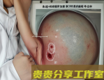 甲状腺结节4类必须手术吗？医生告诉你2025年最新标准